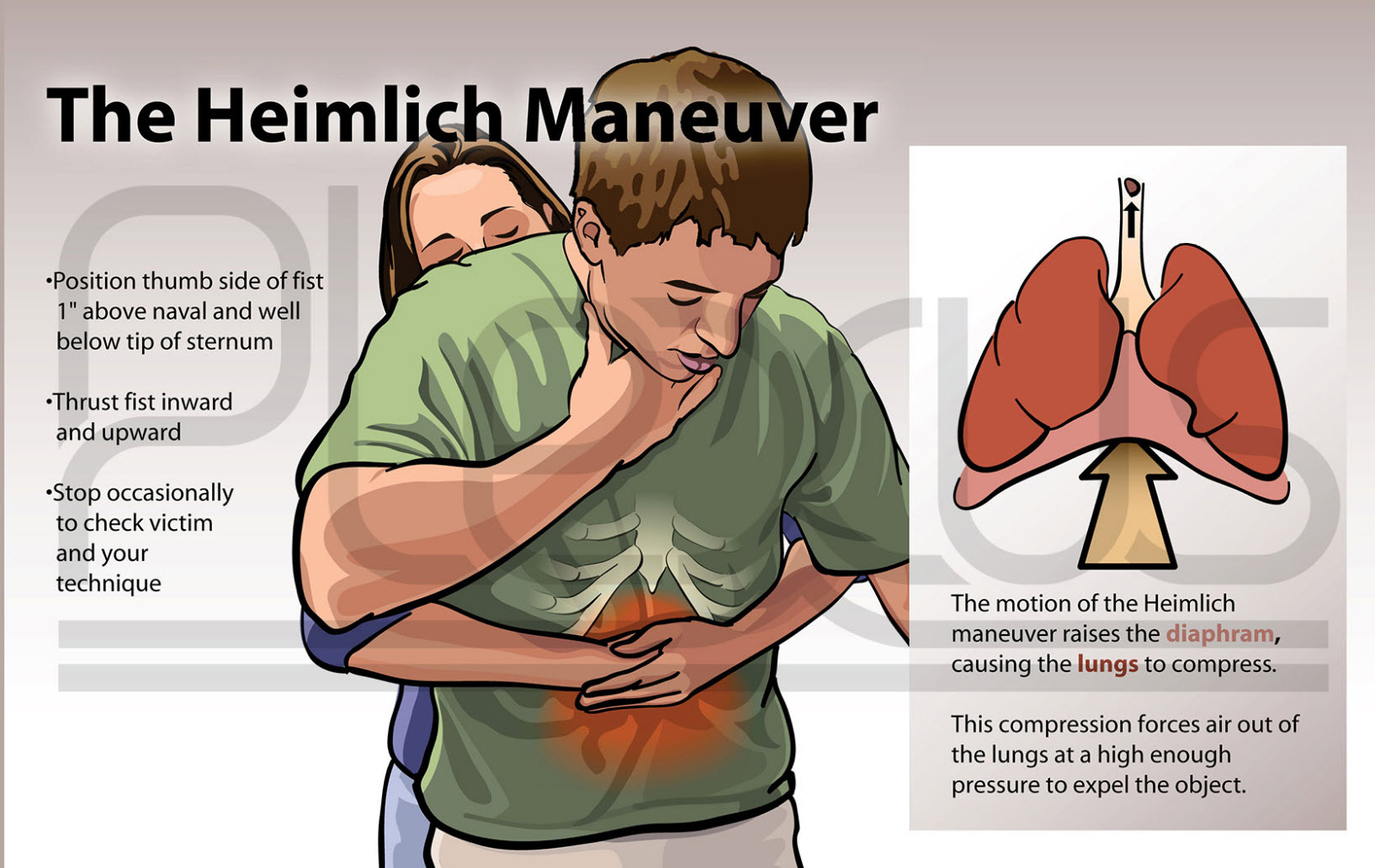 Heimlich maneuver